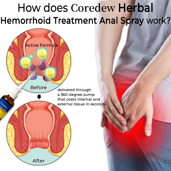 Coredew® Herbal Hemorrhoid Treatment Anal Spray Pro