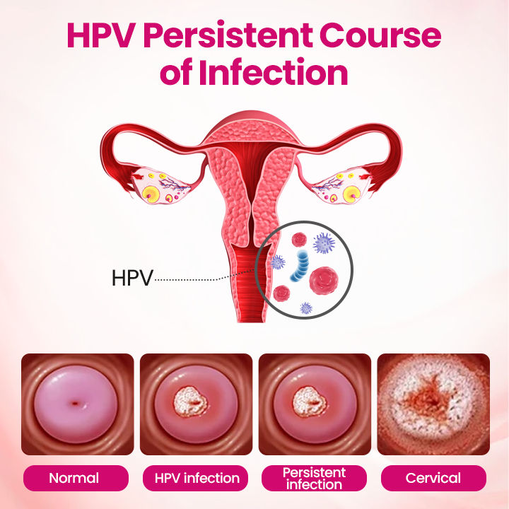 Cpviat® IntiDefend Anti-HPV Interferon Gel